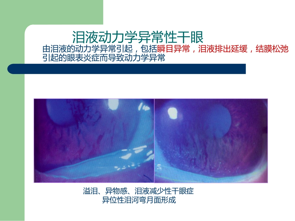干眼症_第11页