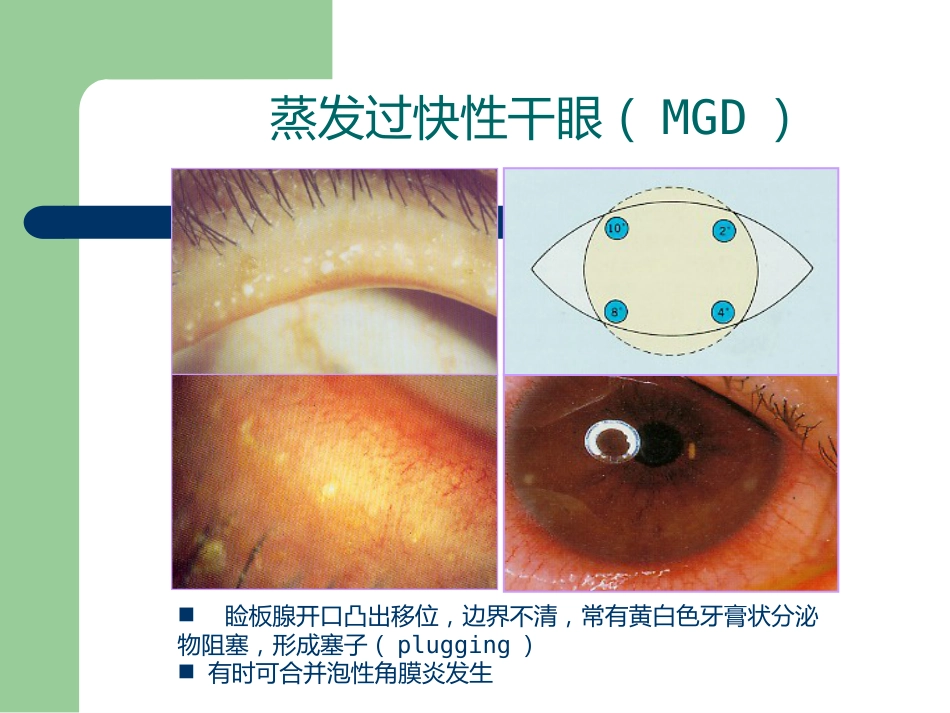 干眼症_第9页