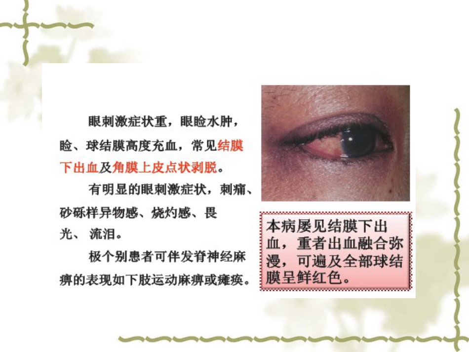 急性出血性结膜炎(1)_第3页