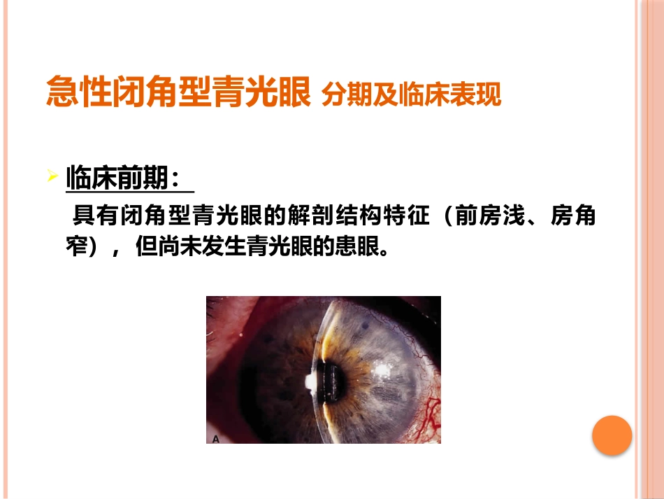 急性闭角型青光眼(1)_第11页