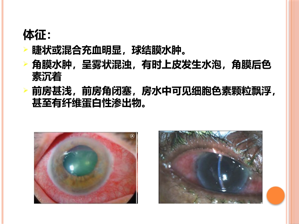 急性闭角型青光眼(1)_第14页