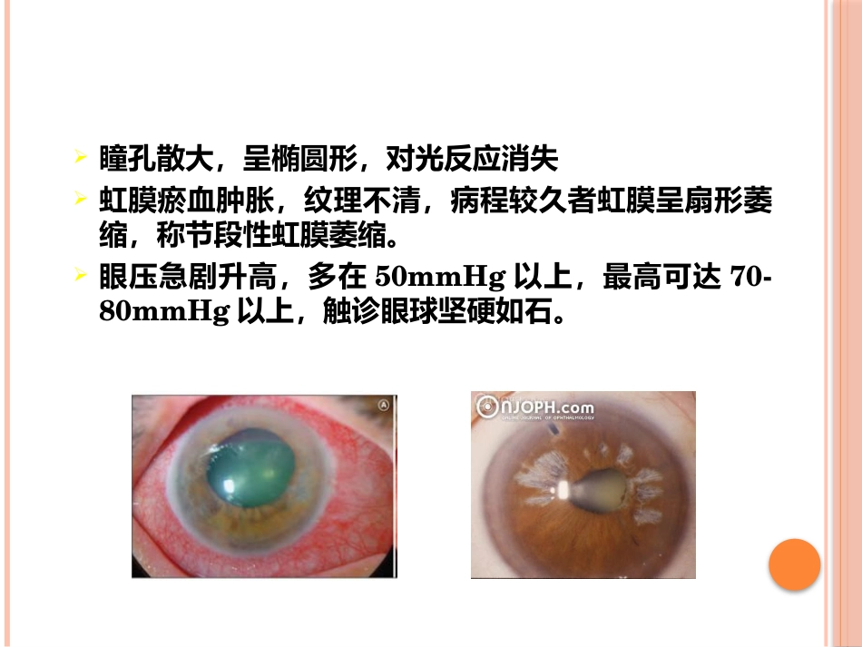 急性闭角型青光眼(1)_第15页