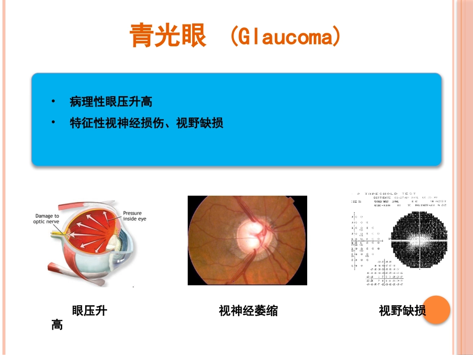急性闭角型青光眼(1)_第3页