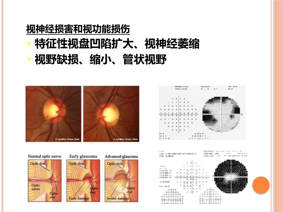 急性闭角型青光眼(1)_第6页