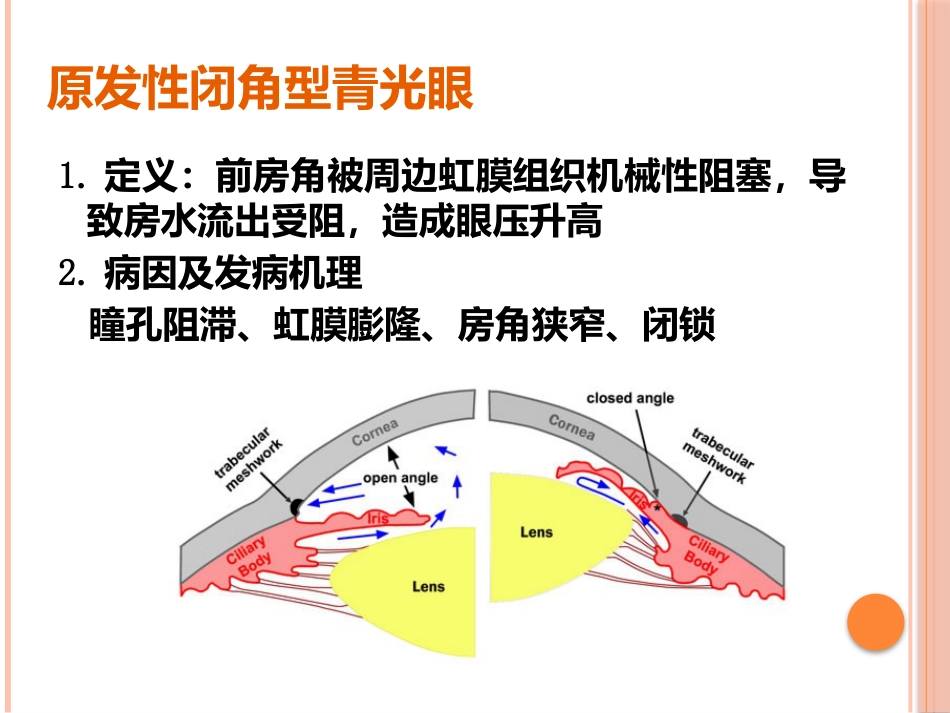 急性闭角型青光眼(1)_第9页