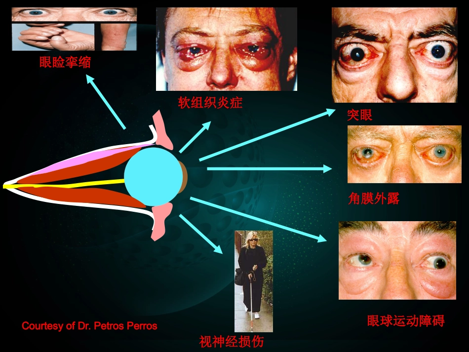 甲状腺相关性眼病(1)_第13页