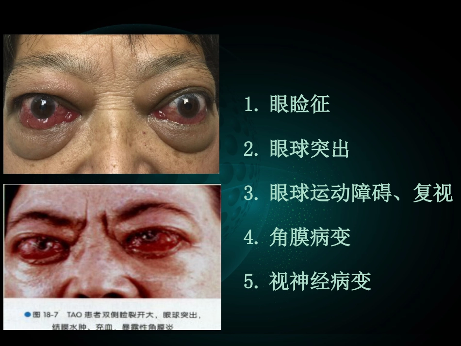 甲状腺相关性眼病(1)_第14页