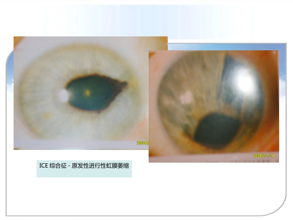 继发性青光眼(1)_第15页