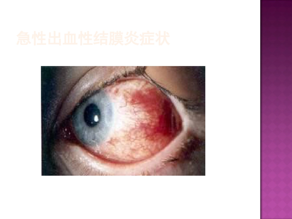 急性出血性结膜炎防治(2)_第11页