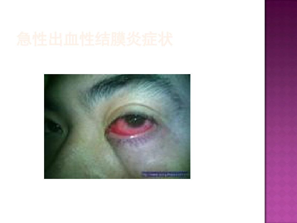 急性出血性结膜炎防治(2)_第12页