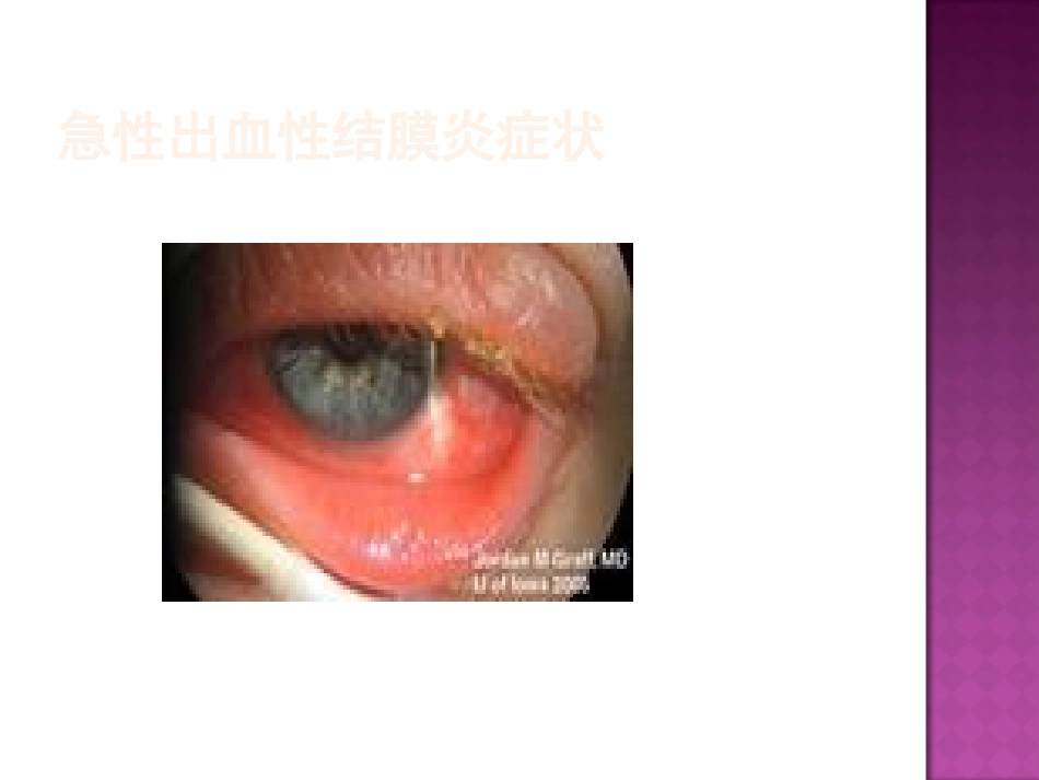 急性出血性结膜炎防治(2)_第13页