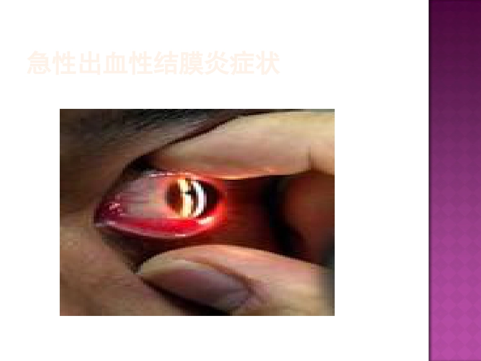 急性出血性结膜炎防治(2)_第14页