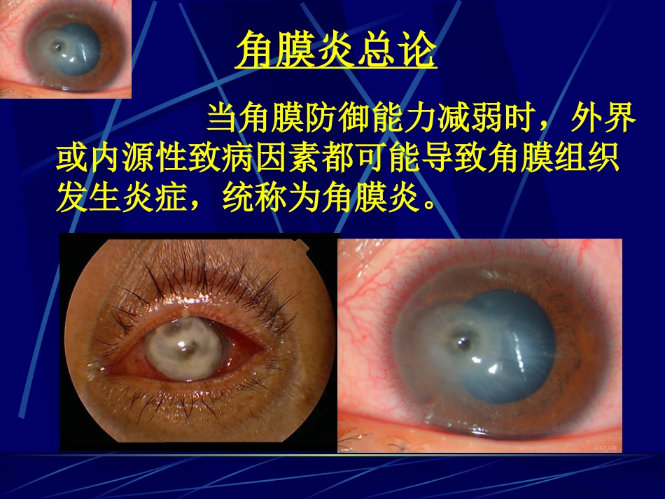角膜病 (3)_第6页