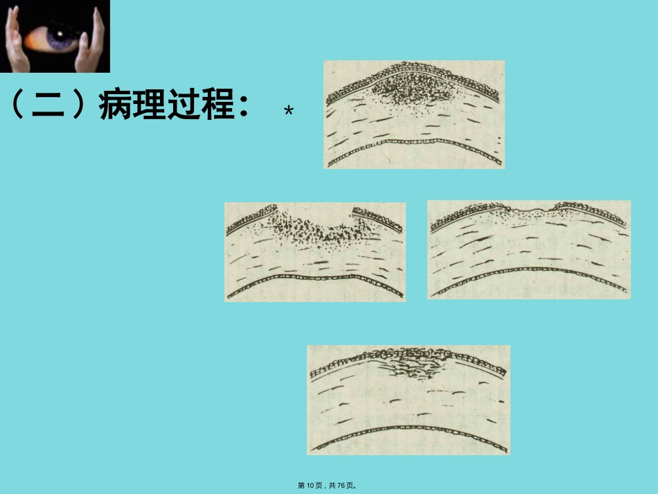 角膜病 (4)_第10页