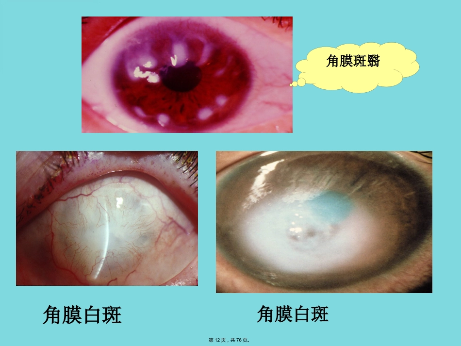 角膜病 (4)_第12页
