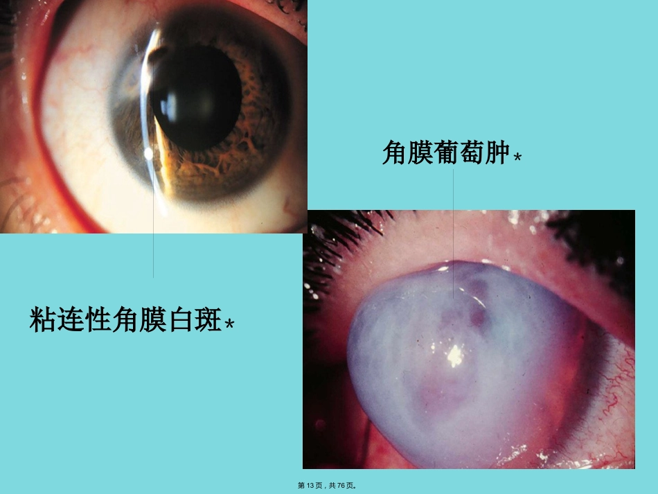 角膜病 (4)_第13页