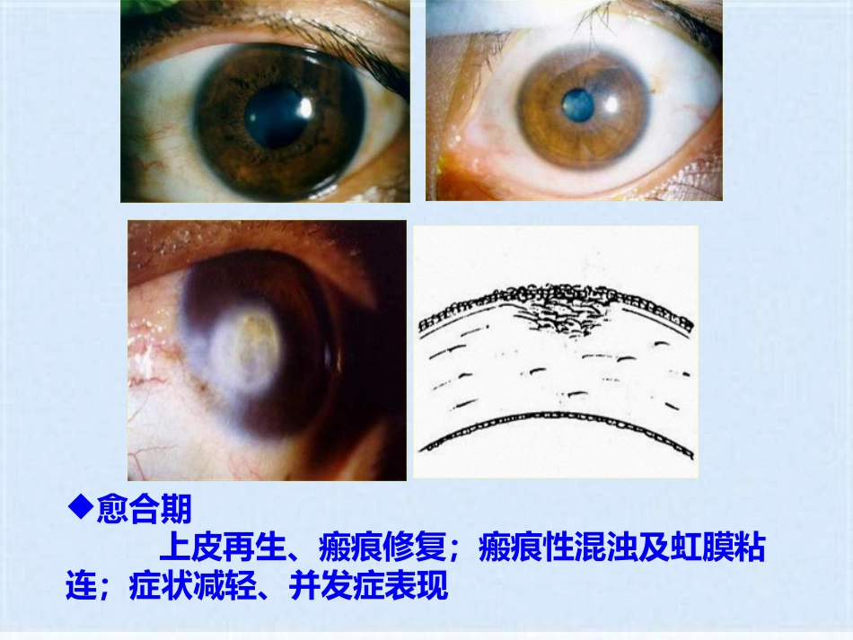 角膜炎的治疗与护理(共40张PPT)_第10页