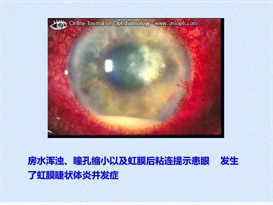 角膜炎的治疗与护理(共40张PPT)_第11页