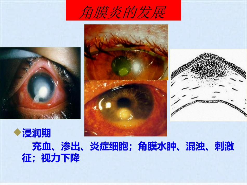 角膜炎的治疗与护理(共40张PPT)_第7页
