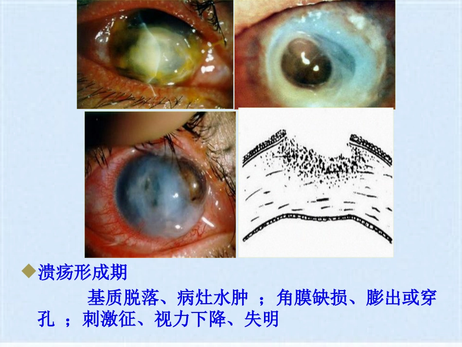 角膜炎的治疗与护理(共40张PPT)_第8页