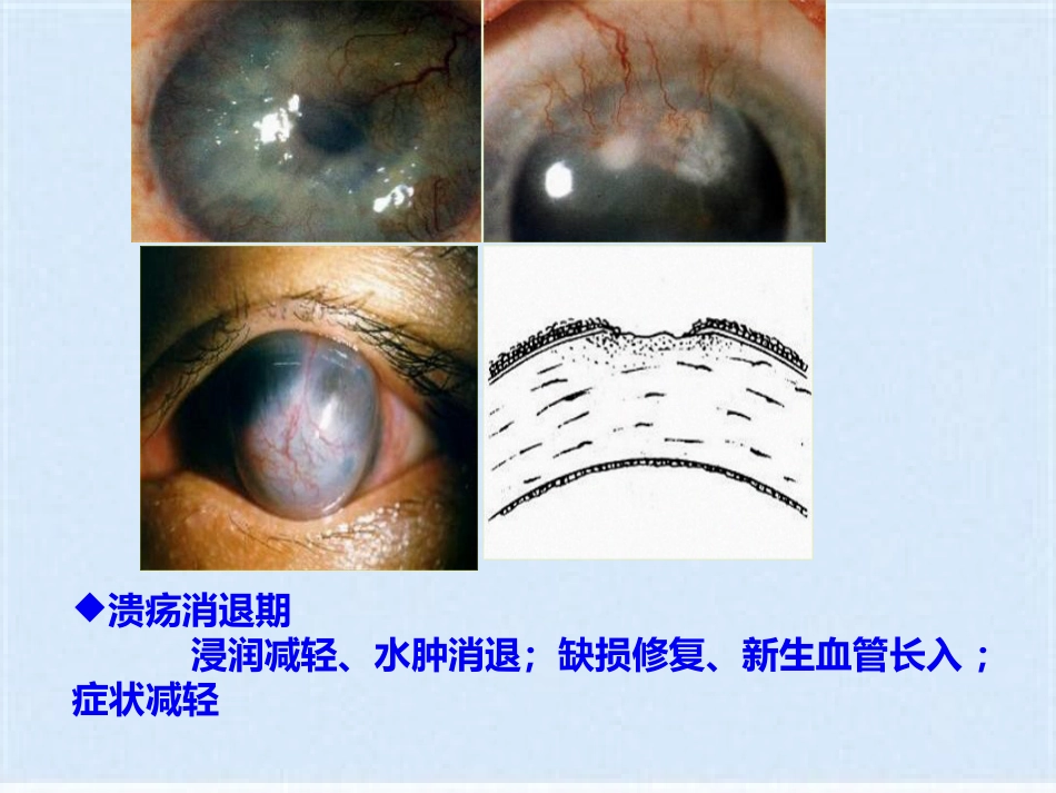 角膜炎的治疗与护理(共40张PPT)_第9页