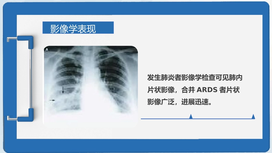 新型冠状病毒感染疫情形势与预防控制_第11页