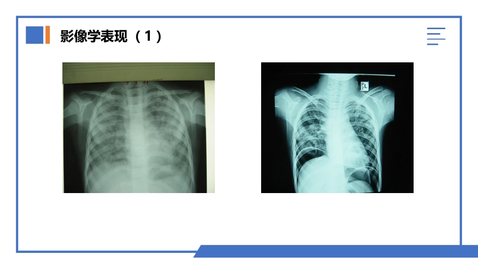 肺部真菌感染_第10页