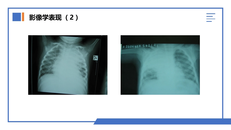 肺部真菌感染_第12页