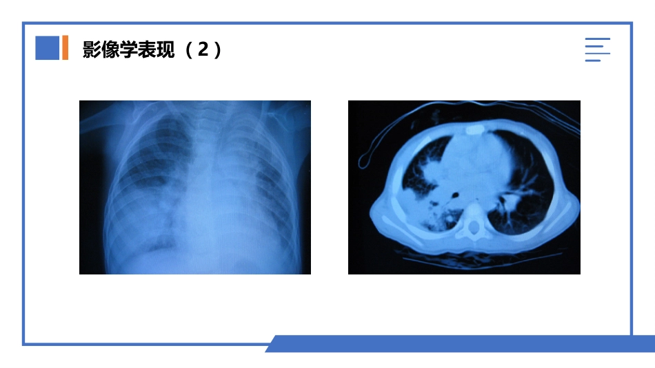 肺部真菌感染_第13页