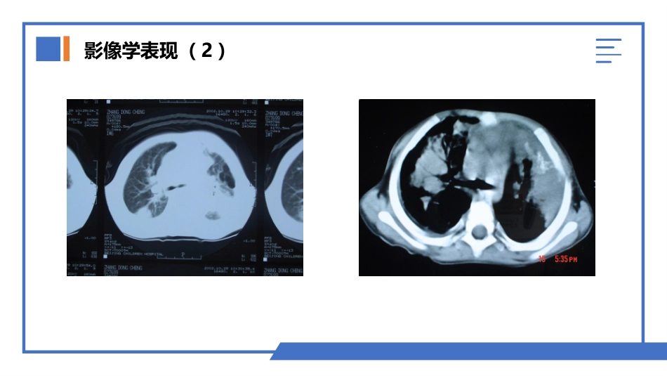 肺部真菌感染_第14页