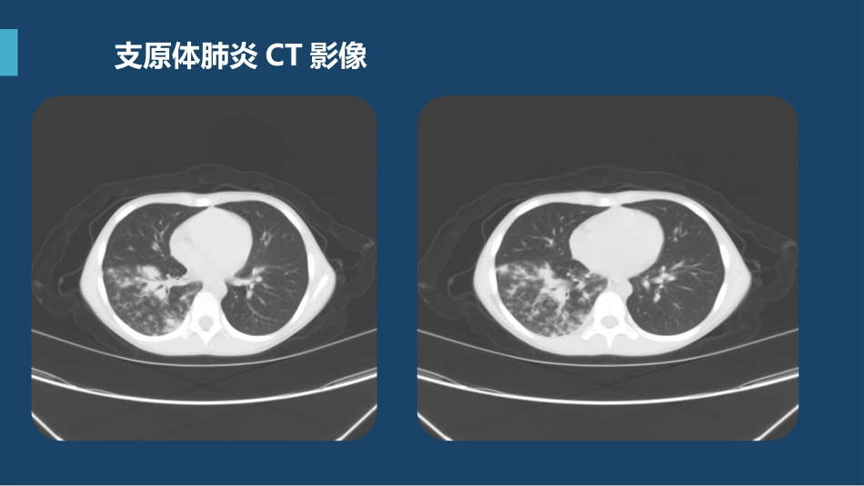 支原体肺炎临床表现及治疗方案（下）_第3页