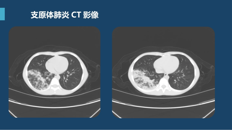 支原体肺炎临床表现及治疗方案（下）_第4页
