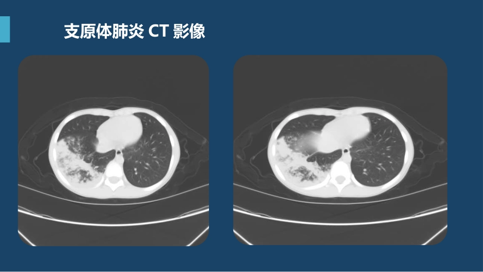 支原体肺炎临床表现及治疗方案（下）_第5页