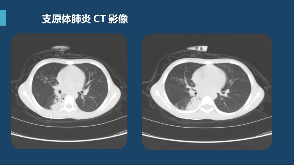 支原体肺炎临床表现及治疗方案（下）_第6页