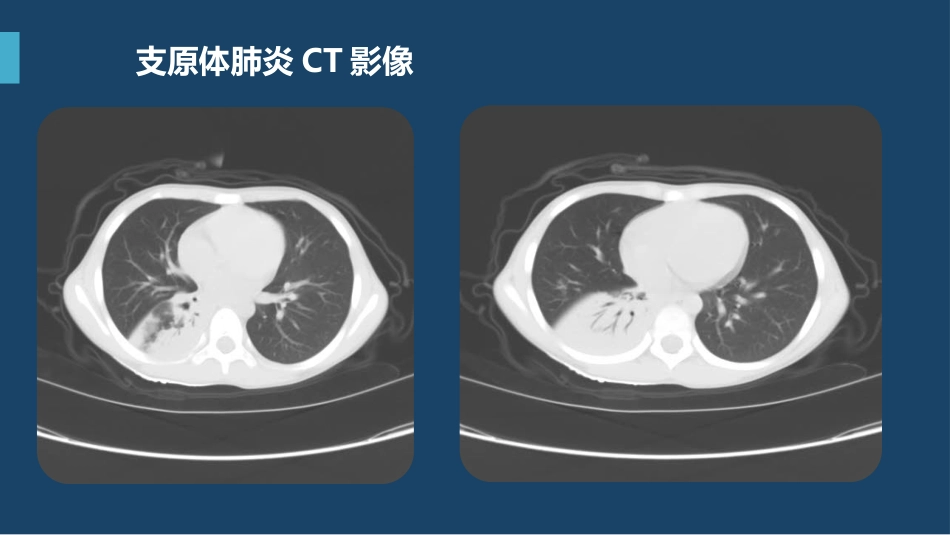 支原体肺炎临床表现及治疗方案（下）_第7页