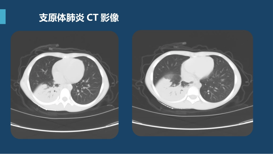 支原体肺炎临床表现及治疗方案（下）_第8页