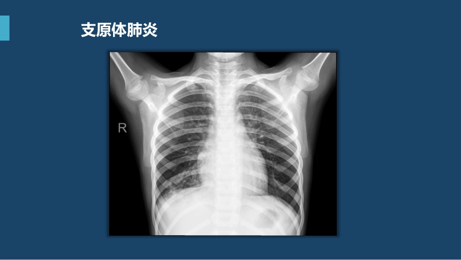 支原体肺炎临床表现及治疗方案（下）_第9页