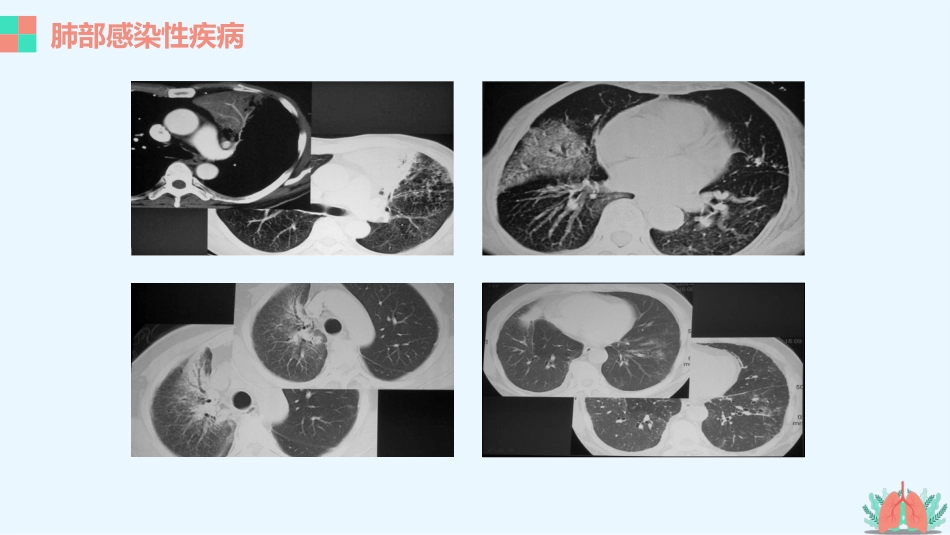 肺部疾病的影像学诊断_第10页