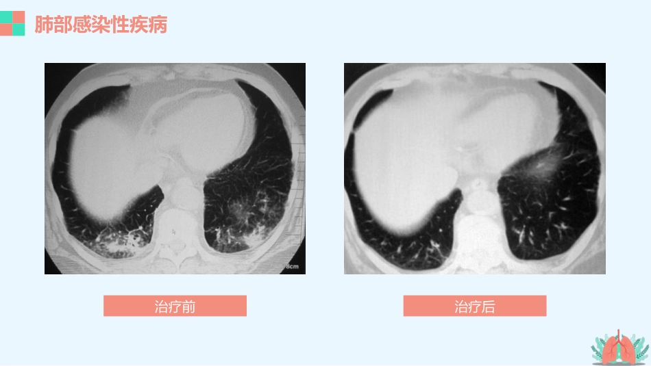 肺部疾病的影像学诊断_第11页