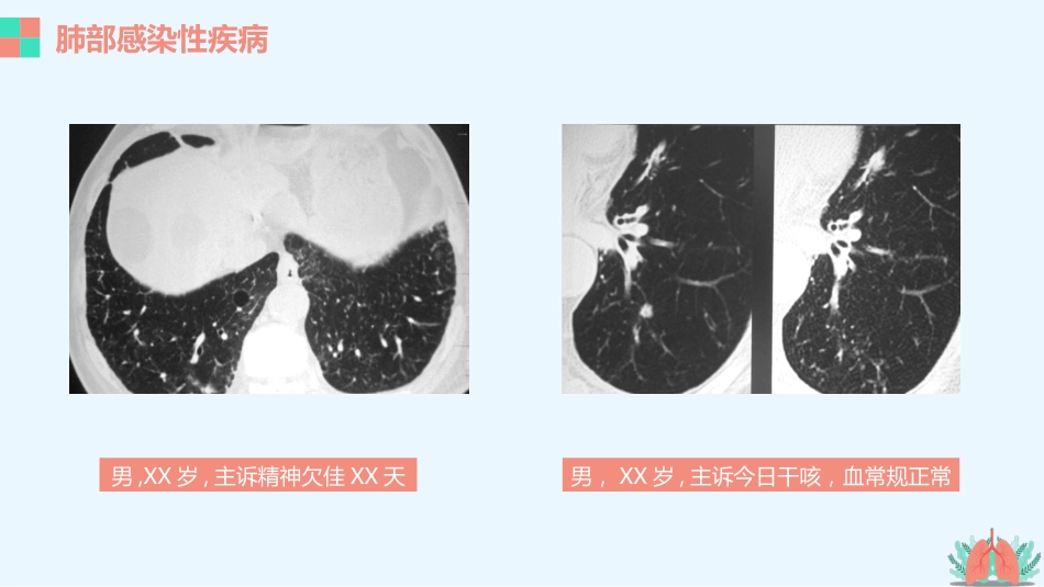 肺部疾病的影像学诊断_第12页