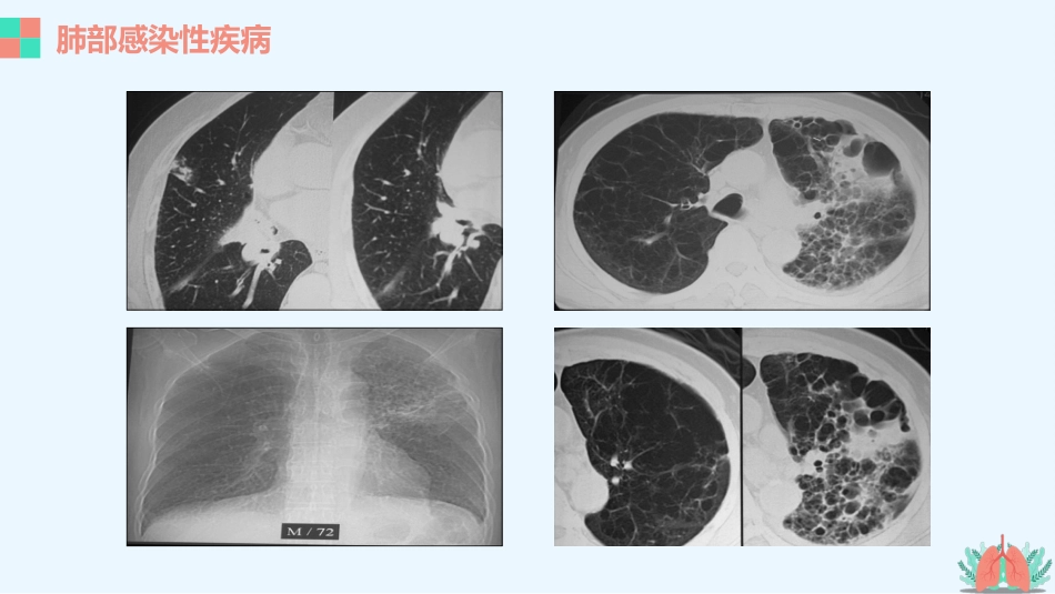 肺部疾病的影像学诊断_第13页