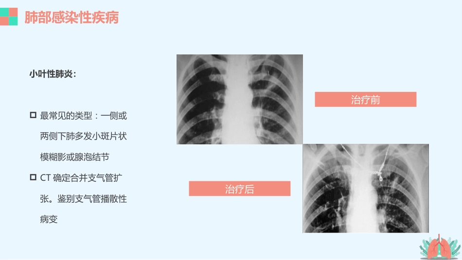 肺部疾病的影像学诊断_第7页