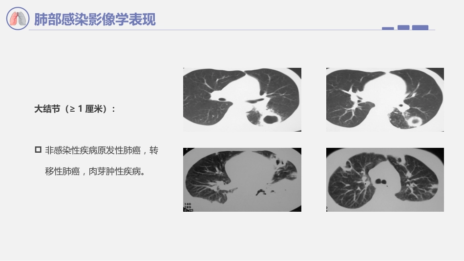 肺部感染影像学表现_第10页