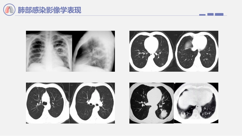 肺部感染影像学表现_第11页
