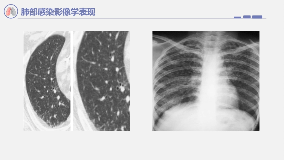 肺部感染影像学表现_第13页