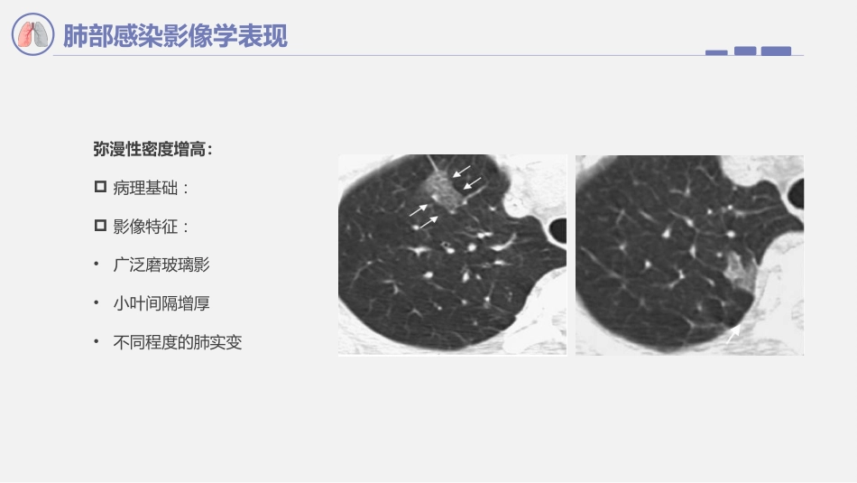 肺部感染影像学表现_第14页