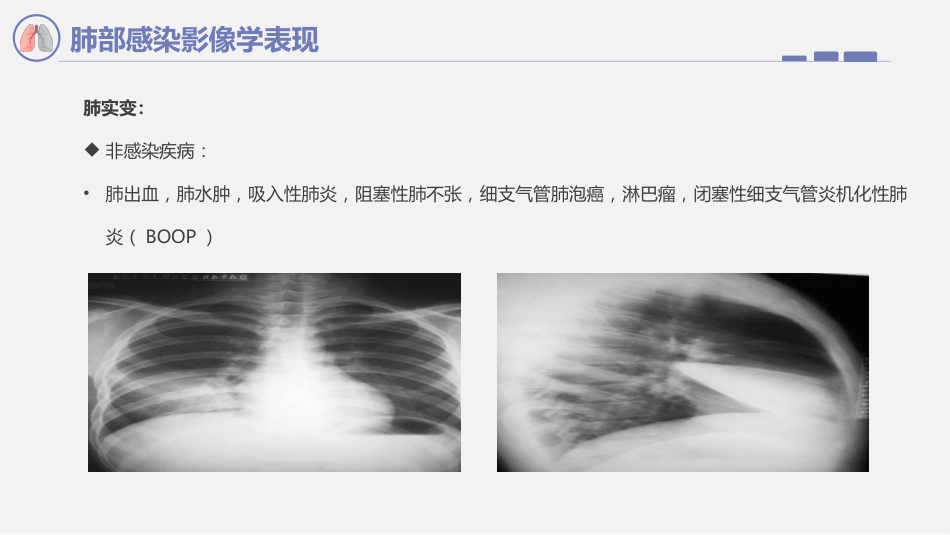 肺部感染影像学表现_第5页