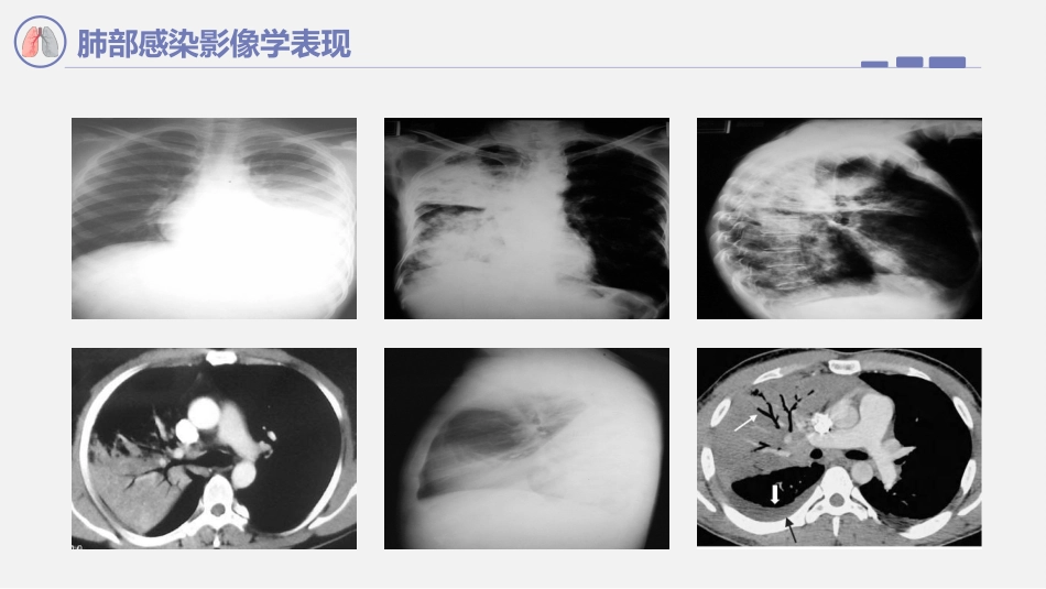 肺部感染影像学表现_第6页