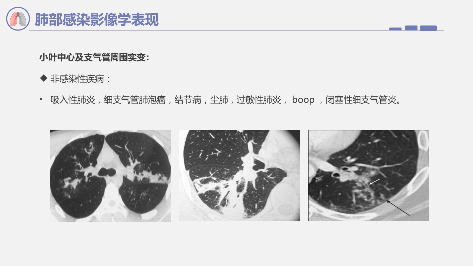 肺部感染影像学表现_第8页