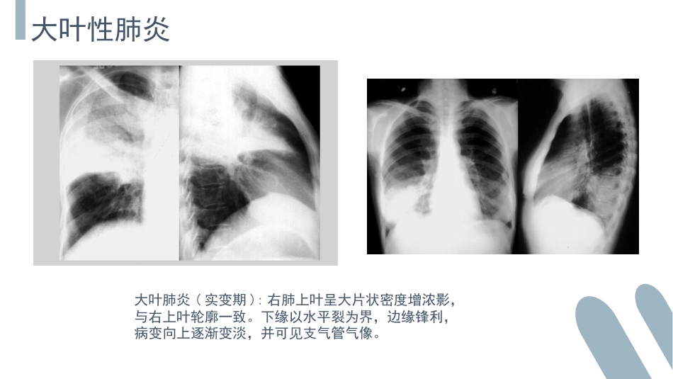 肺部感染介绍_第12页